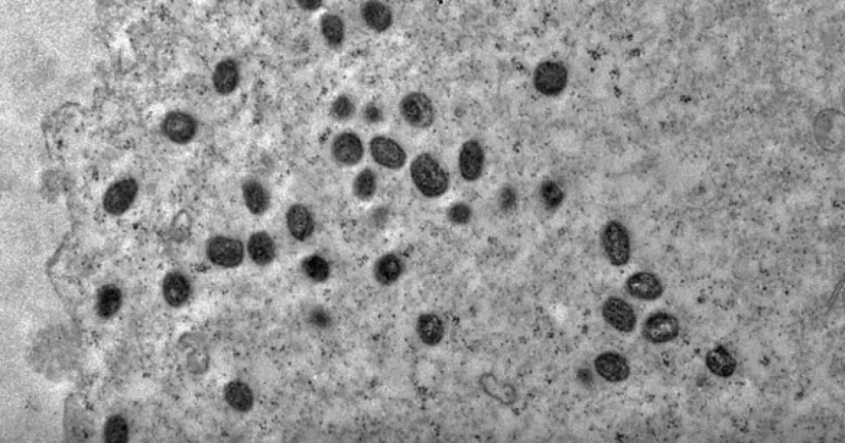 Casos de mpox mais que dobram em 20 dias, com 129 confirmações no Brasil