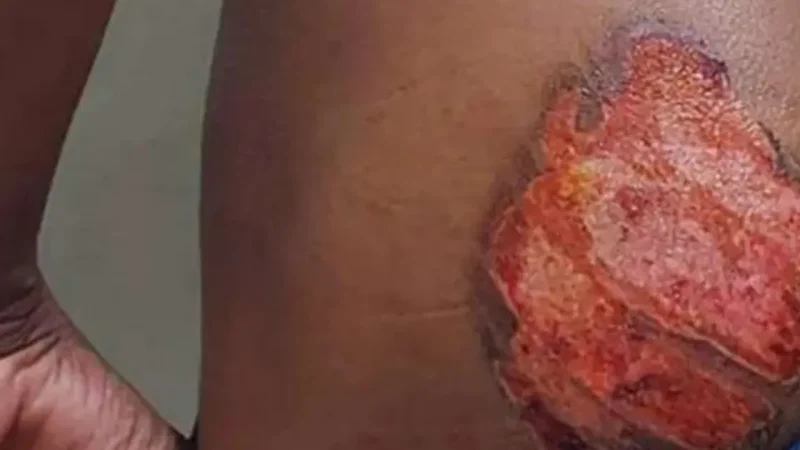 Jovem negro com deficiência auditiva é marcado por ferro no Sudoeste baiano; irmãos são presos